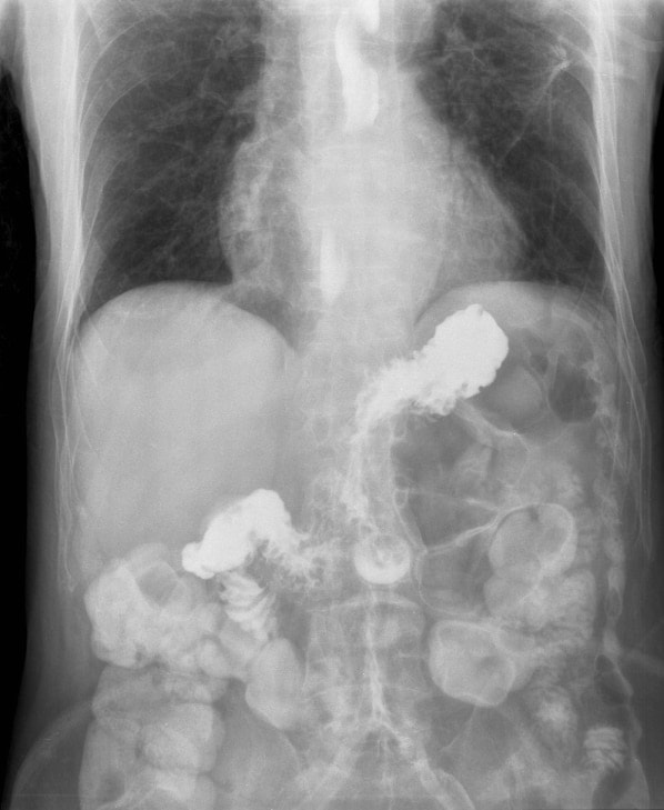 Gastroesophageal reflux barium X ray